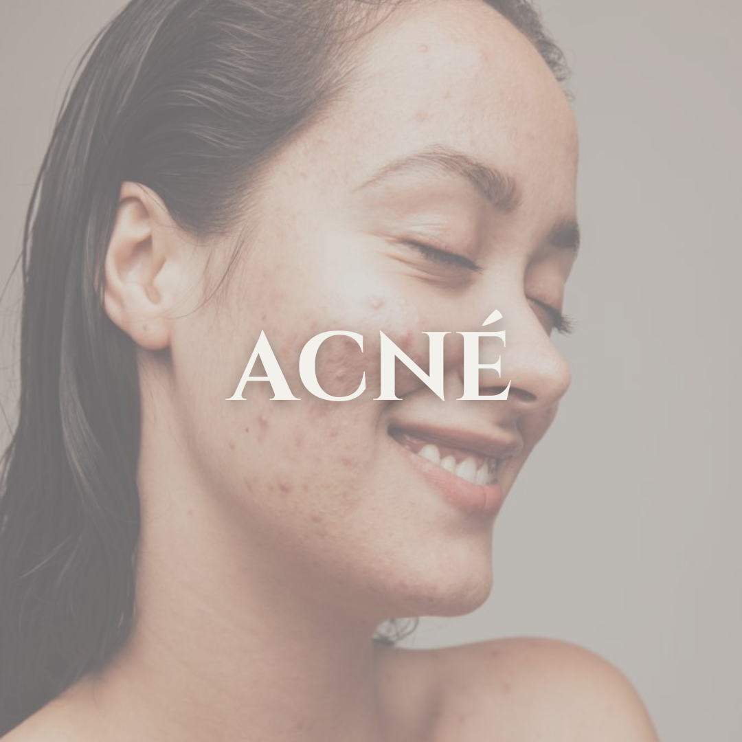 ACNÉ – AMISA BEAUTY STORE